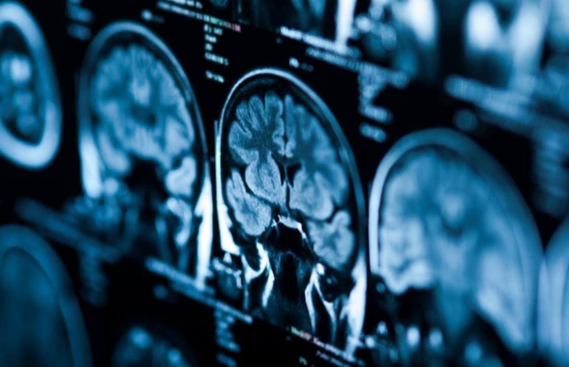 Multiple MRI images of a human brain displayed on a blue-lit medical imaging screen.
